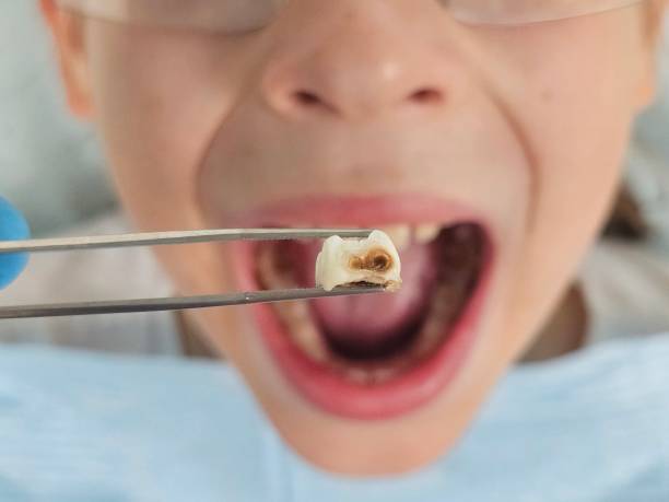 Best Emergency Dental Care for Broken or Chipped Teeth in Virden, IL